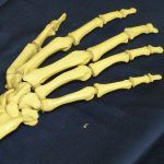 csontritkulás, osteoporosis